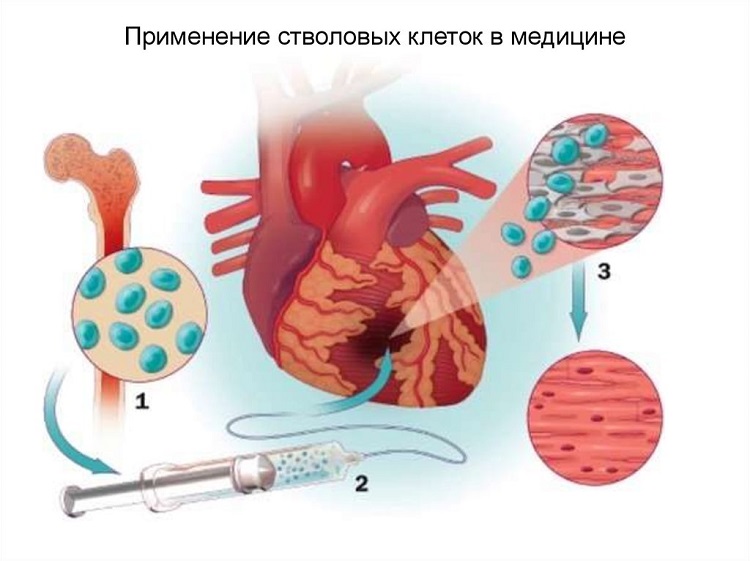 стволовые клетки в медецине